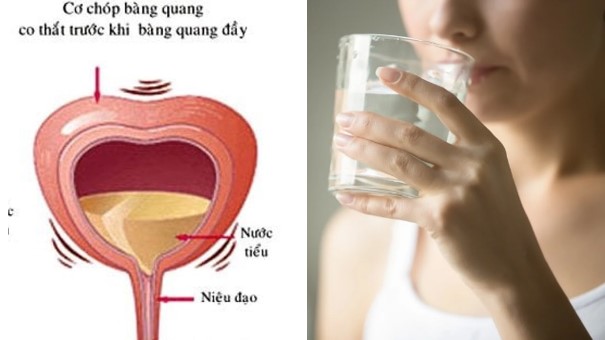   Uống nước không đúng cách có thể gây triệu chứng bàng quang tăng hoạt, hỏng bàng quang  