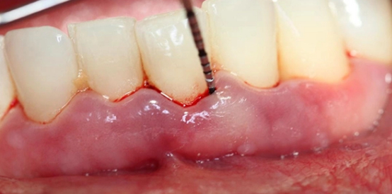 6 dấu hiệu của răng miệng cảnh báo sức khỏe chắc chắn đang có vấn đề 0