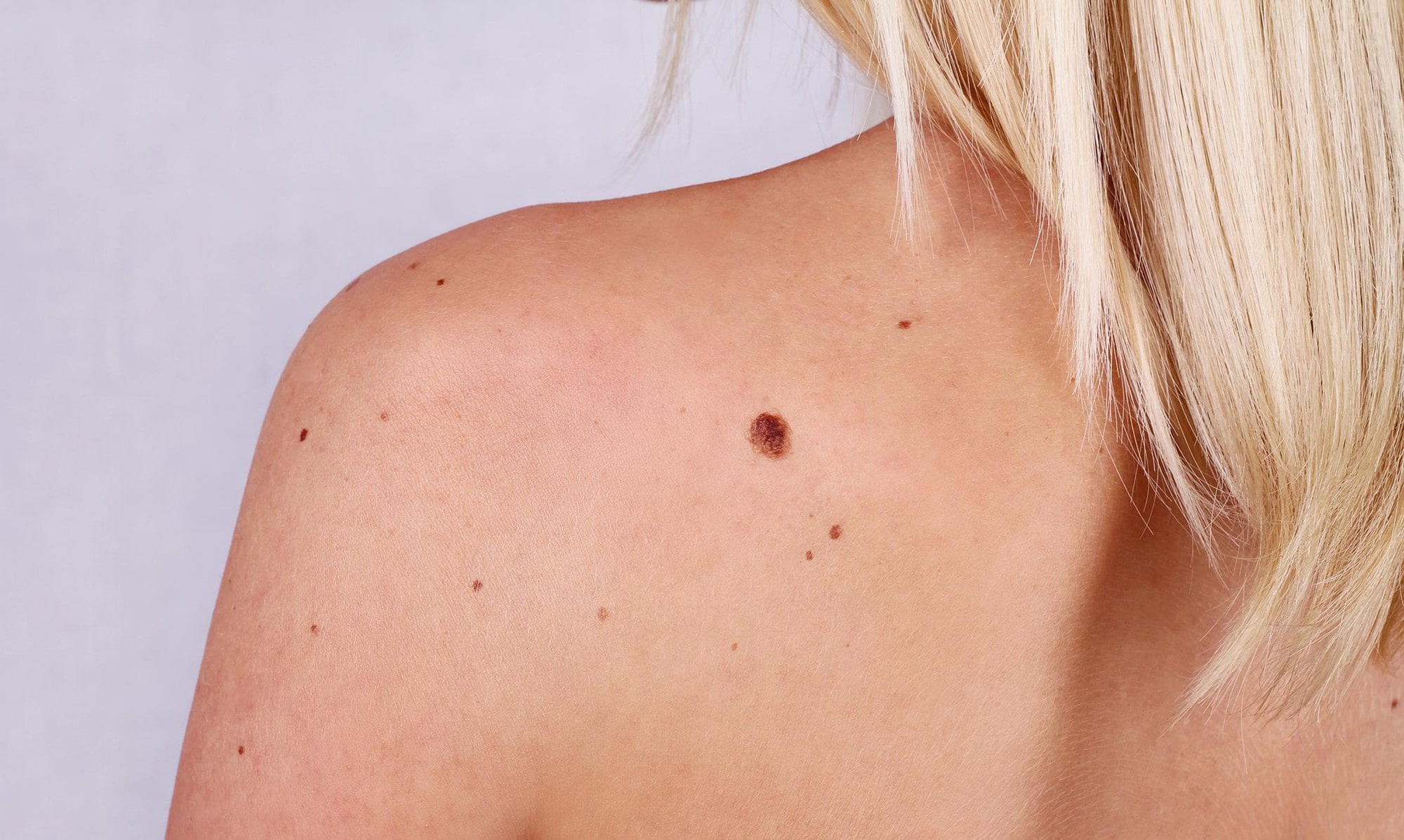   Sự thay đổi về các nốt ruồi trên da cũng có thể là dấu hiệu bệnh về da  