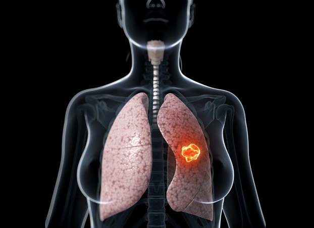 Ung thư phổi có chữa được không? 0