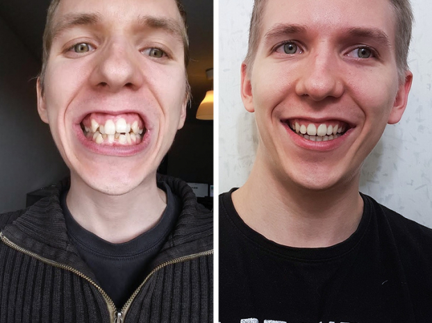  'Sau gần 2 năm, tôi vừa được tháo niềng răng'  