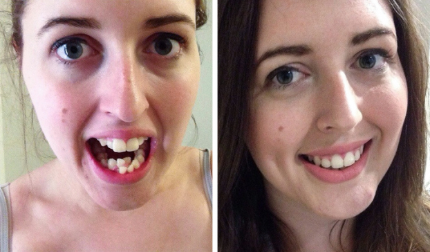   'Tôi vừa tháo niềng răng hôm nay, đây là ảnh trước và sau!'  