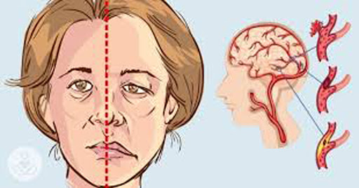   Lệch mặt có thể là dấu hiệu bệnh đột quỵ  