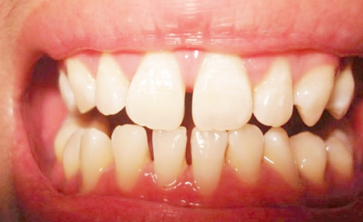 Thói quen dùng tăm xỉa răng sau khi ăn và những tác hại đối với sức khỏe 0