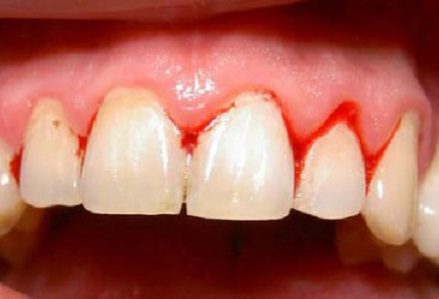 Thói quen dùng tăm xỉa răng sau khi ăn và những tác hại đối với sức khỏe 1