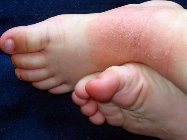   Phù chân, phát ban do nhiệt là những bệnh lý có thể gặp phải khi thời tiết nắng nóng. Ảnh minh họa  