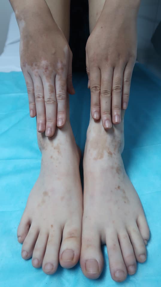   Nên thận trọng khi sử dụng lá trầu không đắp lên da, ngâm chân tay để tránh tác dụng phụ  