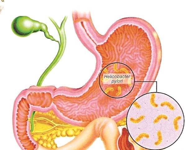   Nhiễm vi khuẩn HP là một trong những nguyên nhân phổ biến gây viêm loét dạ dày - tá tràng. Ảnh minh họa  