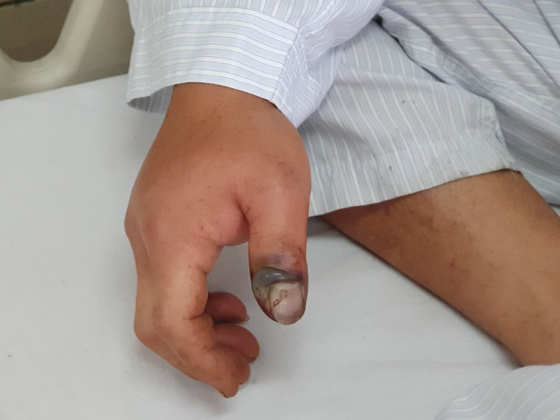   Hình ảnh vết rắn cắn ở ngón cái bàn tay phải bị sưng đỏ, có dấu hiệu hoại tử  