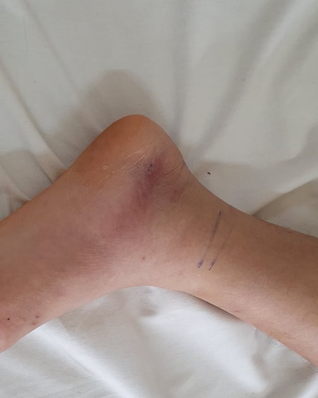   Hình ảnh vết rắn cắn mặt trong bàn chân trái của bệnh nhân  