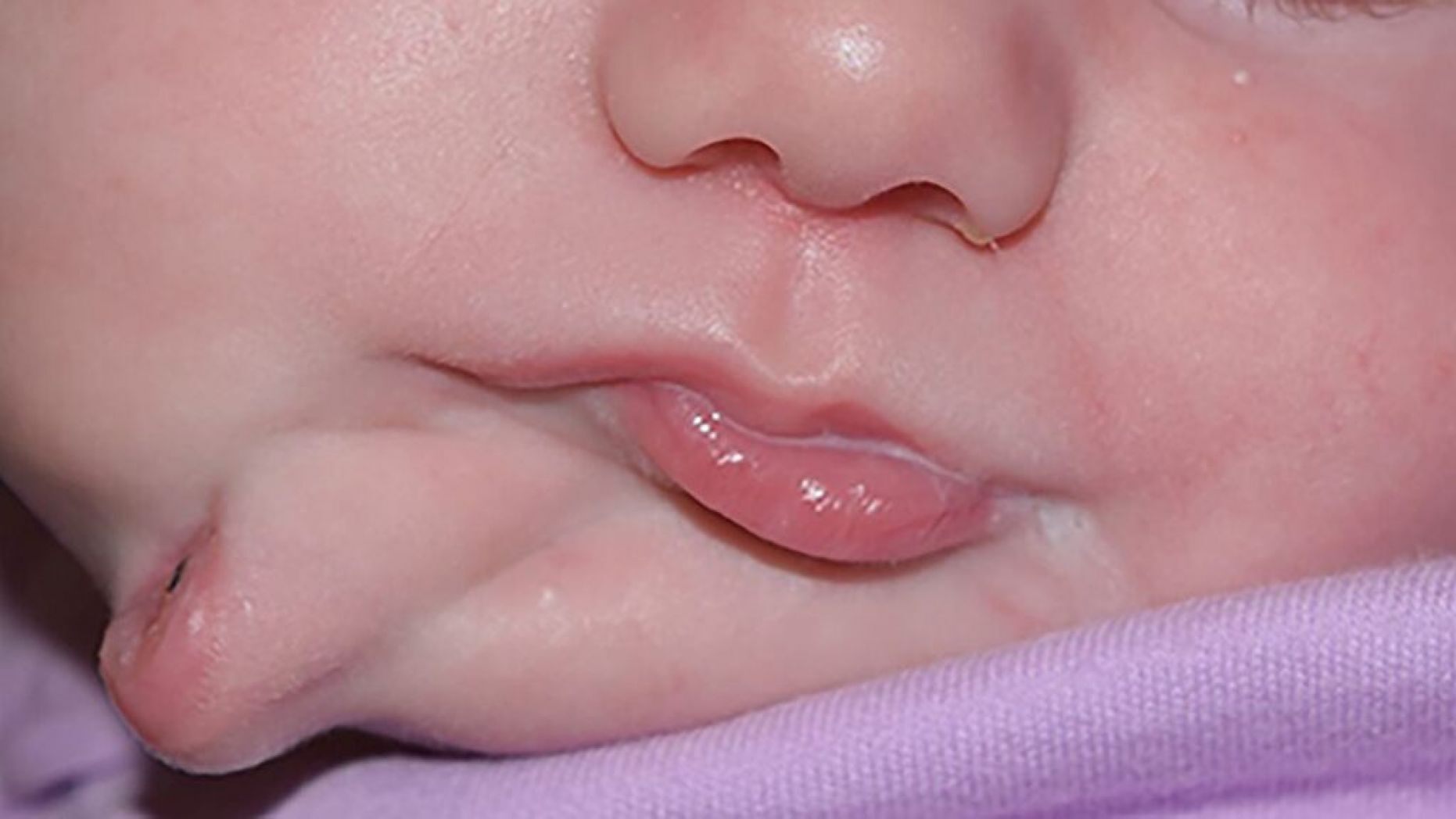   Bé gái sinh ra đã có 2 cái miệng  