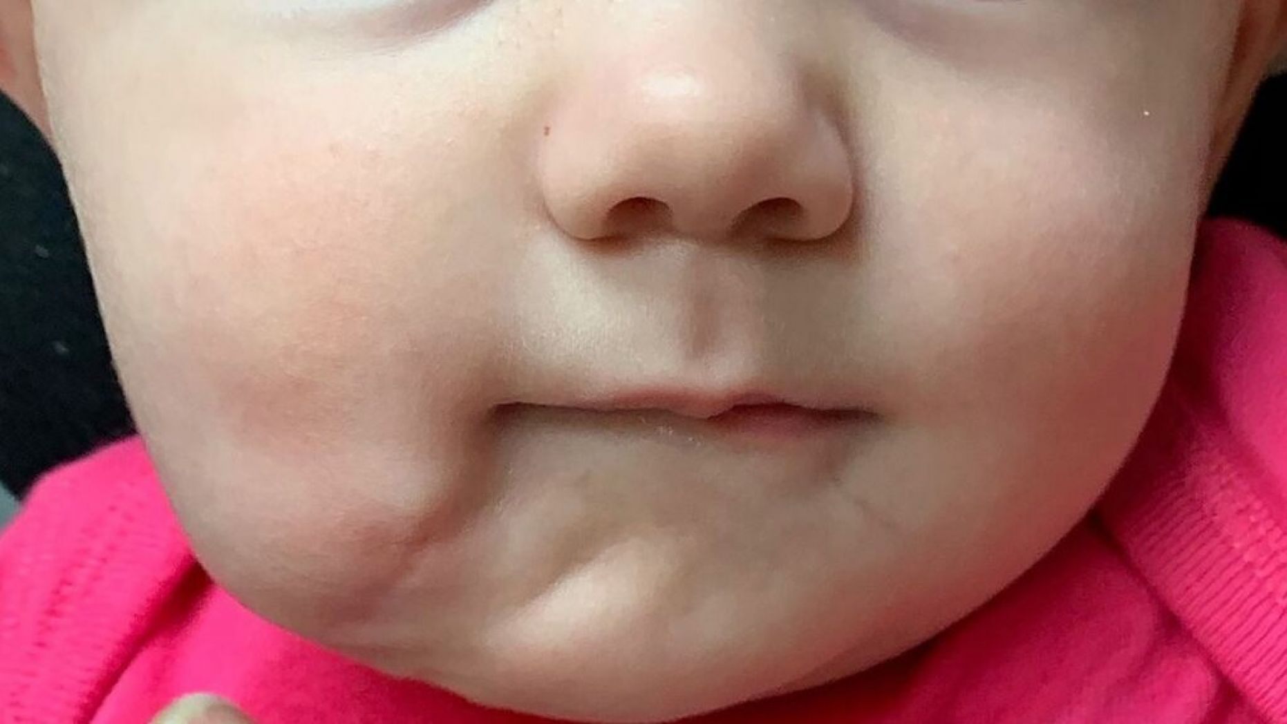   Các bác sĩ đã phẫu thuật loại bỏ cái miệng thừa khi bé được 6 tháng tuổi  