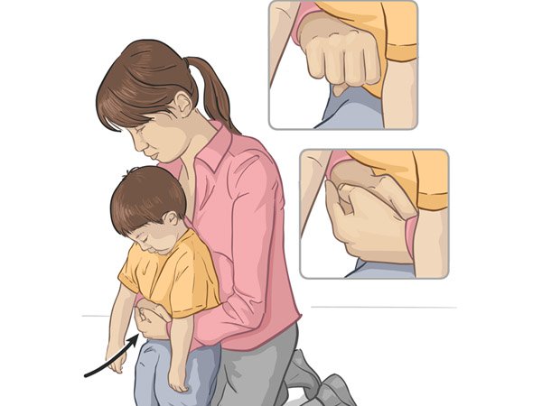   Nghiệm pháp Heimlich để xử trí hóc dị vật cho trẻ. Ảnh minh họa  