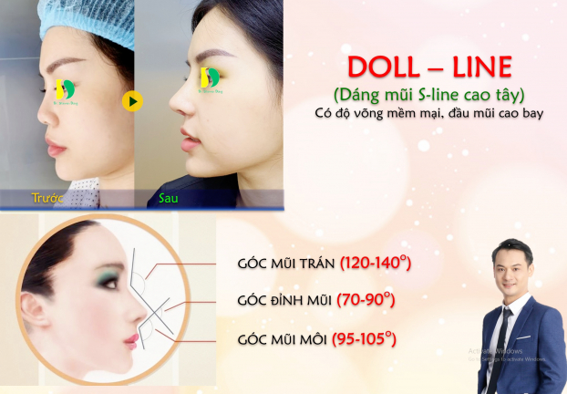Đẹp tự tin với mũi Doll – line thương hiệu Steven Dũng 4