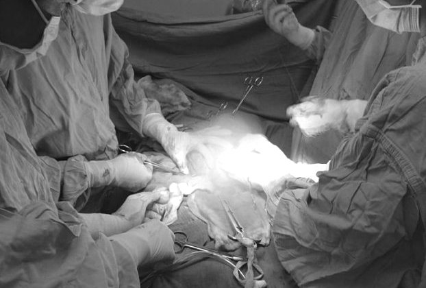   Bác sĩ tiến hành phẫu thuật cắt khối u xơ nặng 5kg, to như thai 16 tuần trong tử cung người phụ nữ  