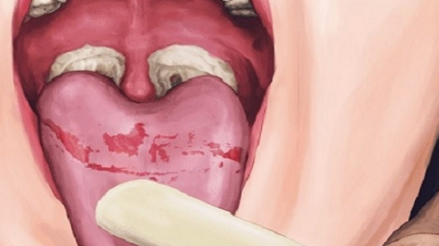   Người bị bệnh bạch hầu ở vùng họng, lưỡi, amidan thường xuất hiện các lớp mảng màu xám dày. Ảnh minh họa  