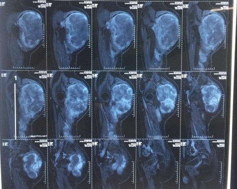   Hình ảnh khối u có kích thước lớn, xâm lấn đè đẩy tổ chức xung quanh, chiếm gần hết vùng mông phải của bệnh nhân  