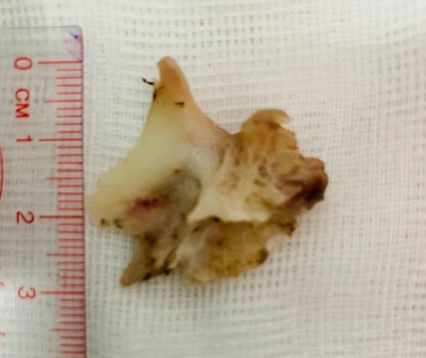   Mảnh xương cá lớn được gắp ra từ thực quản của bệnh nhân  
