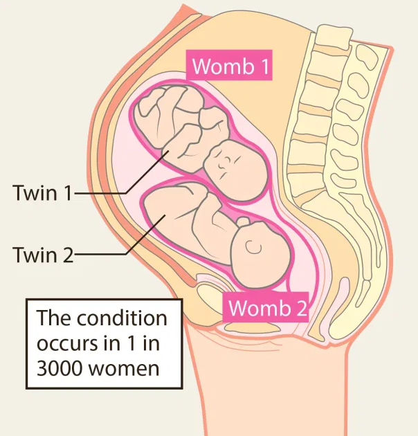   Hình ảnh minh họa trường hợp tử cung đôi  