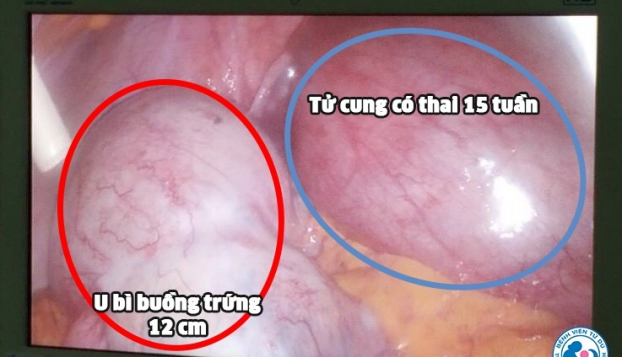   Hình ảnh khối u buồng trứng khủng trong ổ bụng thai phụ  