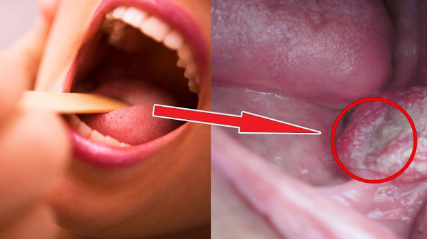   Giả mạc xuất hiện dày, bám chắc ở vùng họng là một trong những triệu chứng riêng của bệnh bạch hầu. Ảnh minh họa  