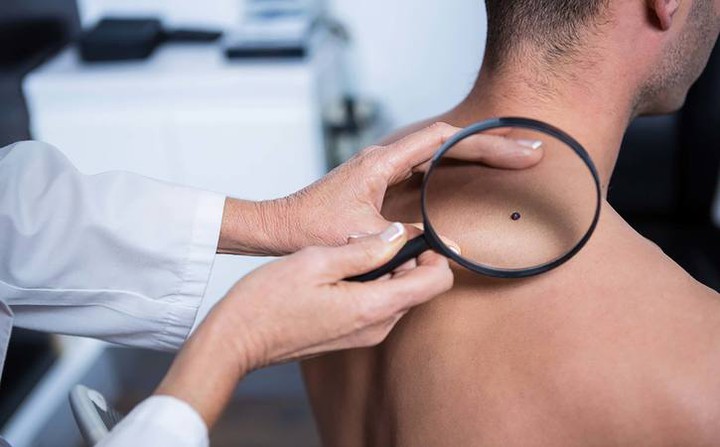   Những thay đổi ở da có thể là dấu hiệu ung thư ở nam giới  
