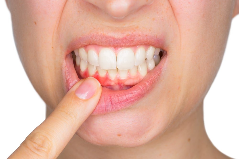   Bệnh nha chu có thể ảnh hưởng đến tim nên bạn cần chăm sóc răng miệng tốt hơn  