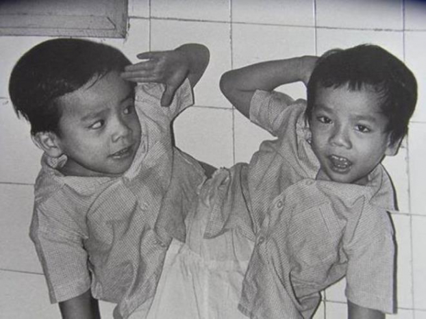   Hai song sinh Việt - Đức lúc còn bị dính liền  
