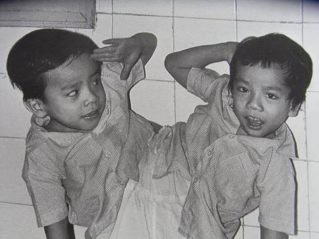   Việt - Đức là cặp song sinh tách rời đầu tiên tại Việt Nam  