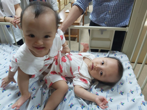   Sức khỏe hai bé Trúc Nhi - Diệu Nhi đang dần ổn định sau phẫu thuật. Ảnh minh họa  