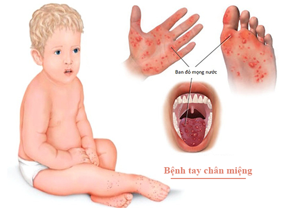Những lưu ý quan trọng khi chăm trẻ bị tay chân miệng để tránh biến chứng nguy hiểm 0