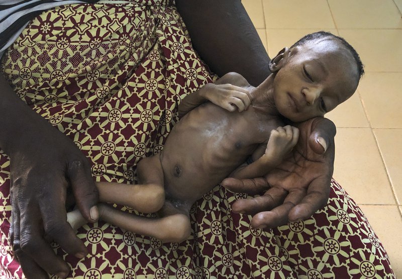   Bé 1 tháng tuổi được điều trị do suy dinh dưỡng nặng ở bệnh viện Burkina Faso.   