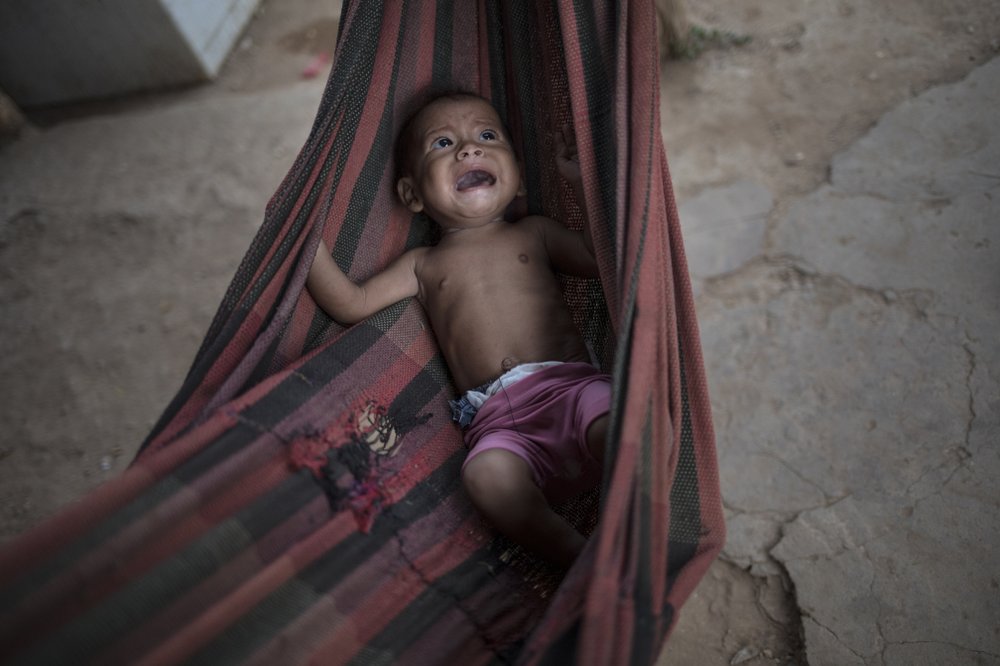   Osmery Vargas, một bé suy dinh dưỡng ở Maracaibo, Venezuela.   