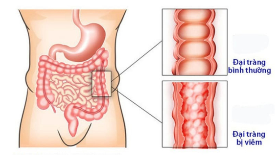 Cách chữa viêm đại tràng bằng lá mơ hiệu quả bất ngờ 0