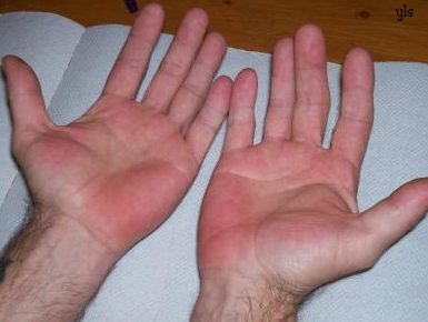   Lòng bàn tay có vùng đỏ bất thường  