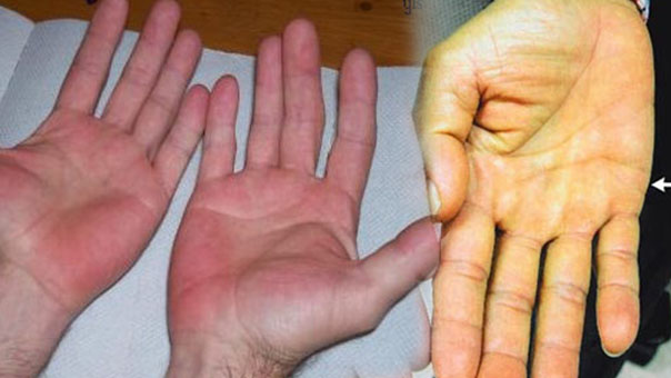   3 dấu hiệu trên bàn tay cảnh báo sớm ung thư mà đa số mọi người thường bỏ qua  