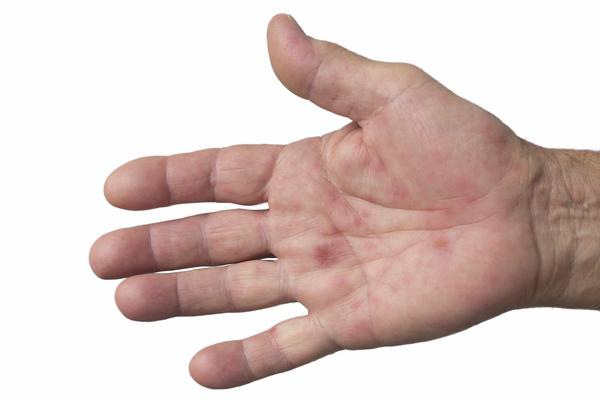 3 dấu hiệu trên bàn tay cảnh báo sớm ung thư mà đa số mọi người thường bỏ qua 1