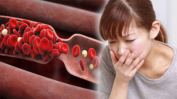   4 dấu hiệu nguy hiểm sau khi ăn cảnh báo mạch máu bị tắc nghẽn, dễ xảy ra đột quỵ  