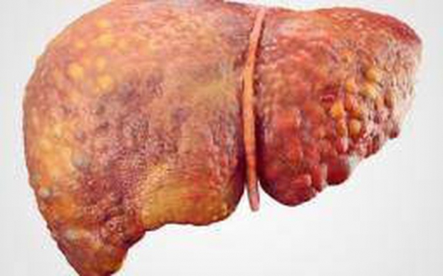 3 bất thường xuất hiện trên cơ thể báo hiệu bệnh gan đã chuyển thành ung thư 0