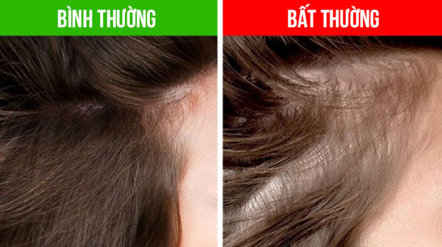 8 dấu hiệu bất thường từ mái tóc cảnh báo vấn đề sức khỏe trong cơ thể 4