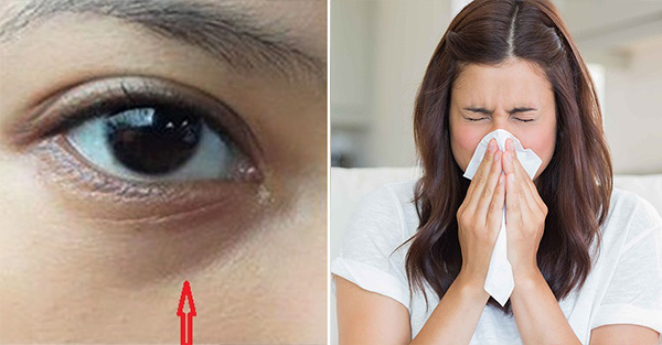   Mắt thâm quầng chưa chắc do thiếu ngủ, đó có thể là dấu hiệu của nhiều căn bệnh nguy hiểm  