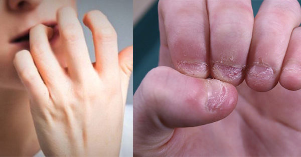   5 hiểm họa khôn lường với sức khỏe từ thói quen cắn móng tay hàng ngày của nhiều người  
