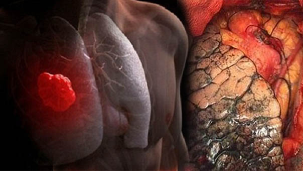   5 tín hiệu 'kêu cứu' của phổi, cần ngay lập tức đi khám ngay kẻo ung thư đang đến rất gần  
