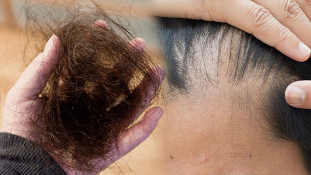   Rụng tóc nhiều bất thường là dấu hiệu của 6 căn bệnh nguy hiểm, hãy đi khám ngay lập tức  