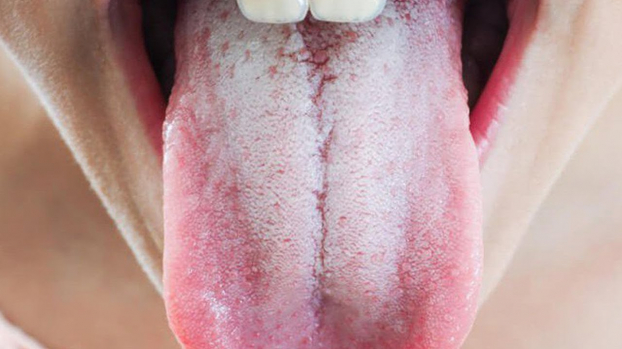 Đoán nhanh 14 chứng bệnh của cơ thể thông qua việc nhìn vào biểu hiện của lưỡi 0