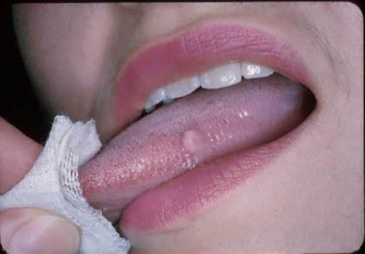 Đoán nhanh 14 chứng bệnh của cơ thể thông qua việc nhìn vào biểu hiện của lưỡi 1