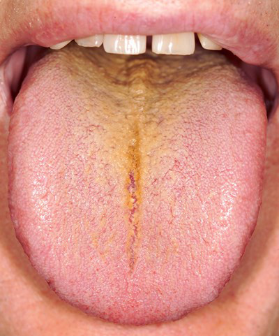 Đoán nhanh 14 chứng bệnh của cơ thể thông qua việc nhìn vào biểu hiện của lưỡi 2