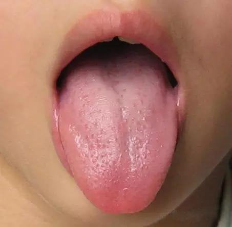 Đoán nhanh 14 chứng bệnh của cơ thể thông qua việc nhìn vào biểu hiện của lưỡi 3