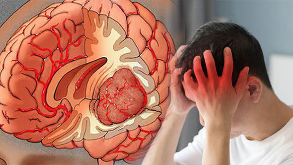 2 triệu chứng xuất hiện cùng lúc cảnh báo căn bệnh u não đang đến rất gần, cần khám ngay 0