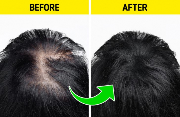 7 mẹo giúp tóc mọc lại tự nhiên và trị hói đầu hiệu quả 4